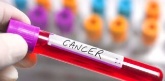 Ces signes très étranges qui peuvent révéler un cancer